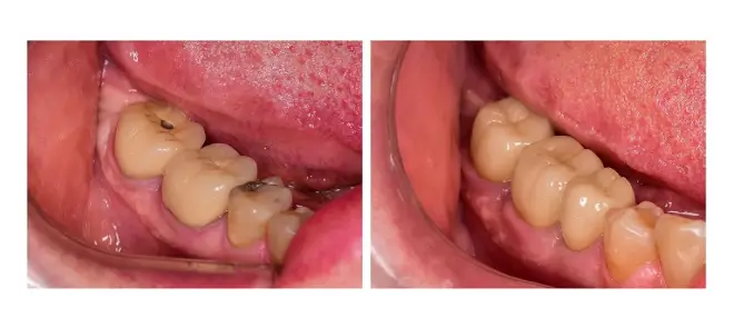 Tooth crown replacement results 